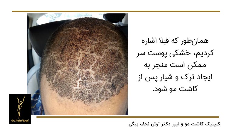 خشکی پوست سر و ایجاد ترک