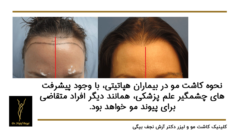 نحوه کاشت مو در بیماران هپاتیتی