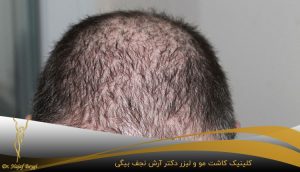 کاشت مو برای بیماران ام اس