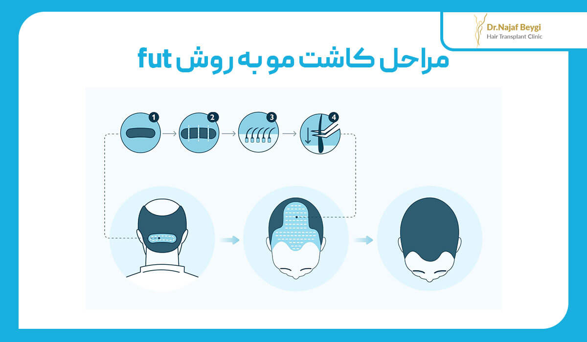 کاشت مو به روش FUT