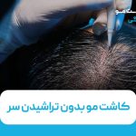 کاشت مو بدون تراشیدن سر