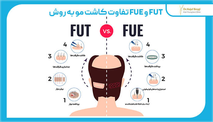 تفاوت کاشت مو به روش FUE و FUT