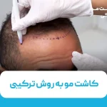 کاشت مو به روش ترکیبی