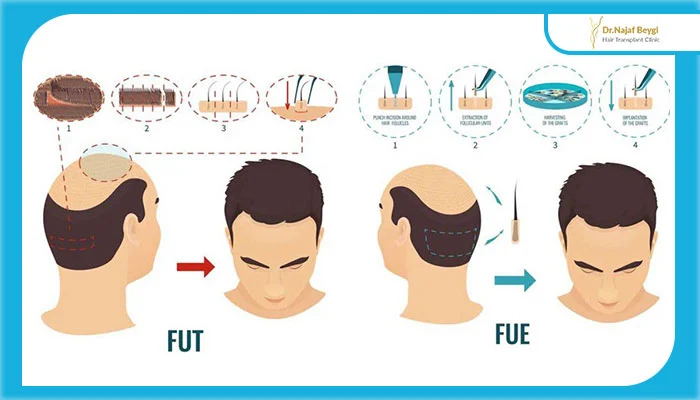 کاشت مو به روش ترکیبی