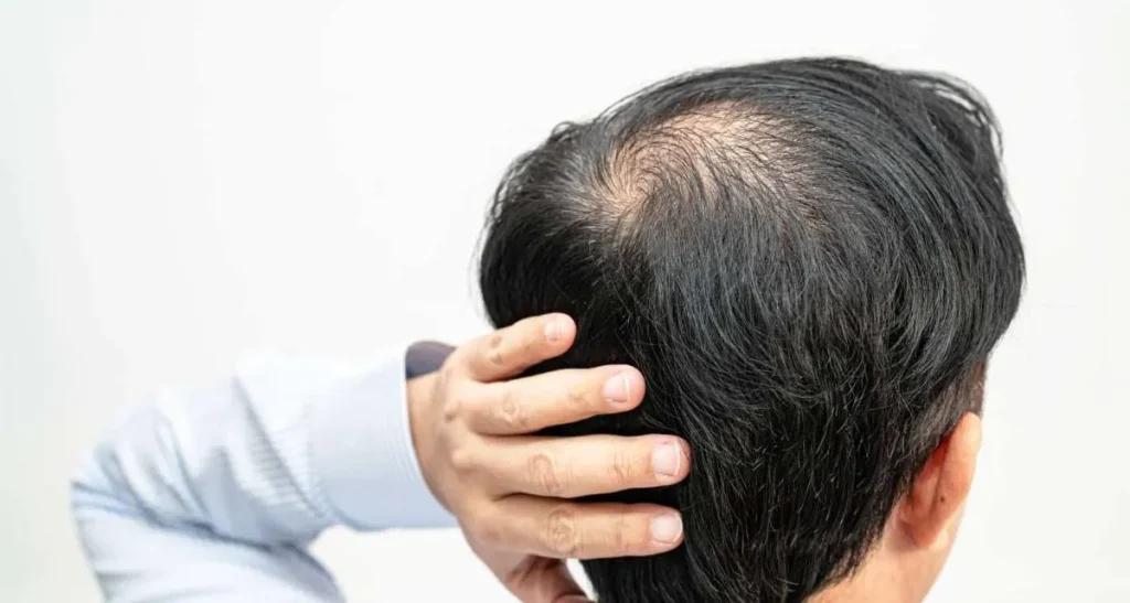 ارتباط هورمون ها در ریزش موی سر