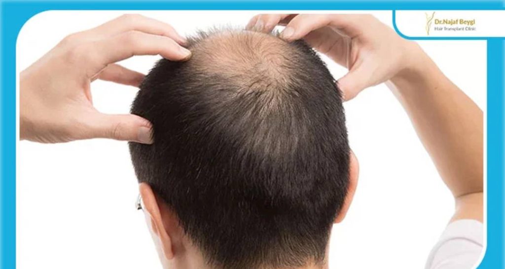 بانک مو چیست و در کجای سر قرار دارد