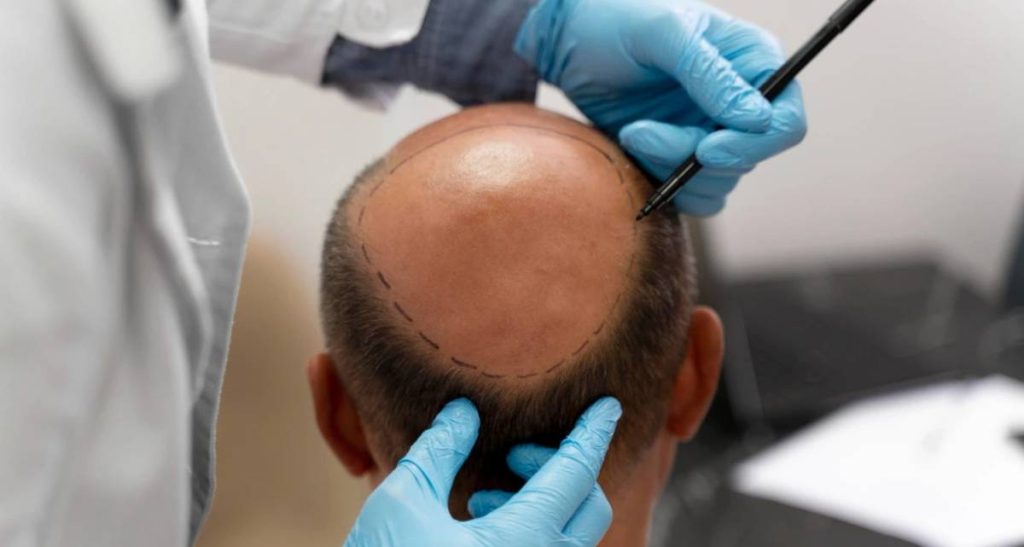 بانک مو چیست و در کدام قسمت از سر قرار دارد