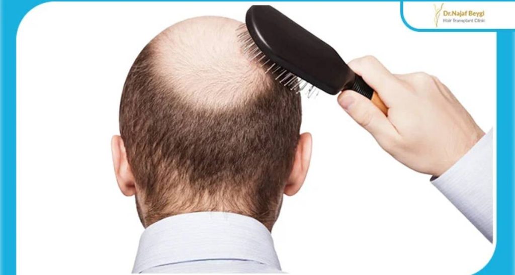 بهترین ناحیه بانک مو برای کاشت مو