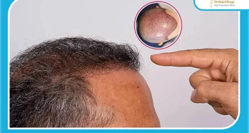 نشانه های کاشت مو موفق