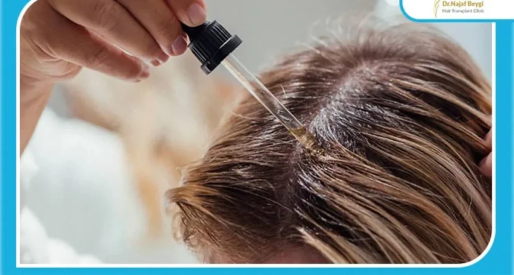 نکات مهم کاشت مو برای موی چرب