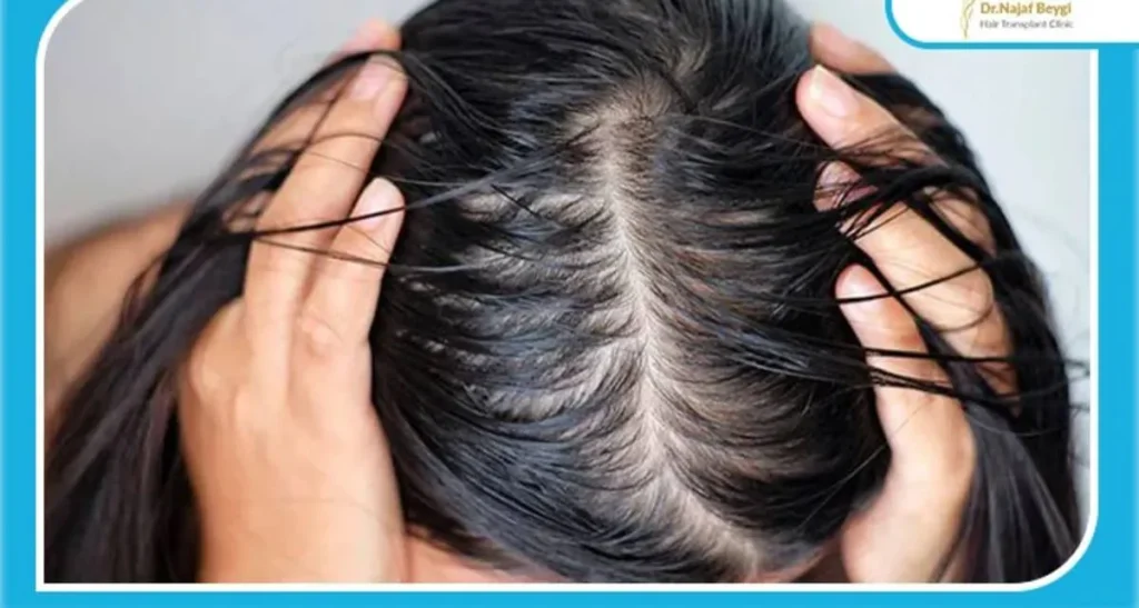 کاشت مو برای سر چرب در بانوان