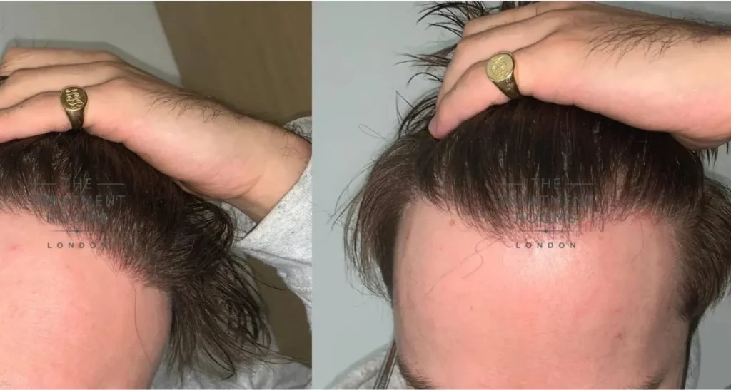 کاشت مو برای کف سر چرب آقایان