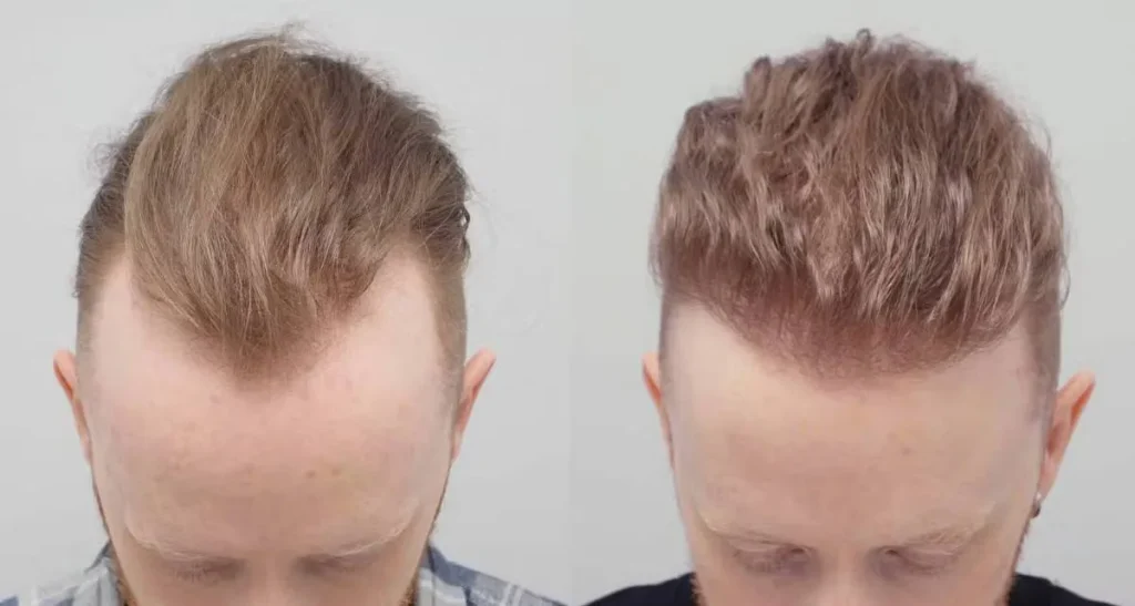 تفاوت کاشت مو با ترمیم مو چیست؟