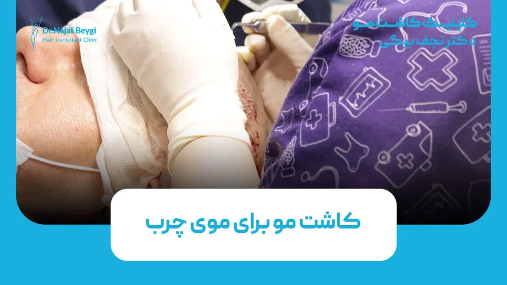 کاشت مو برای موی چرب