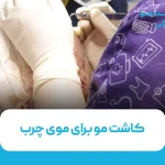 کاشت مو برای موی چرب