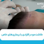 کاشت مو در افرادی با بیماری‌های خاص