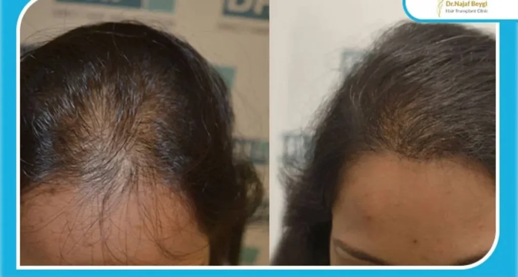 هزینه کاشت موی بلند دخترانه