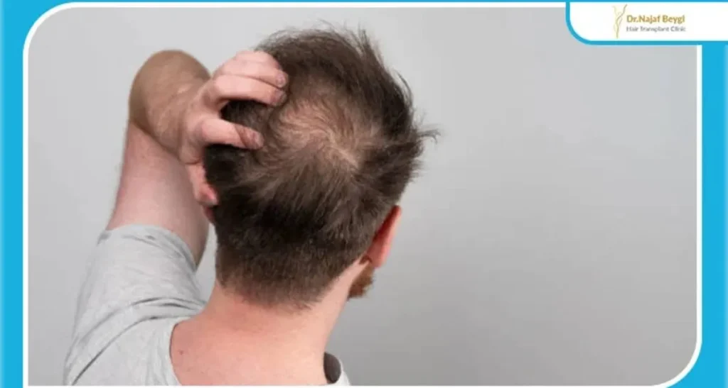 ریزش شدید و ناگهانی مو