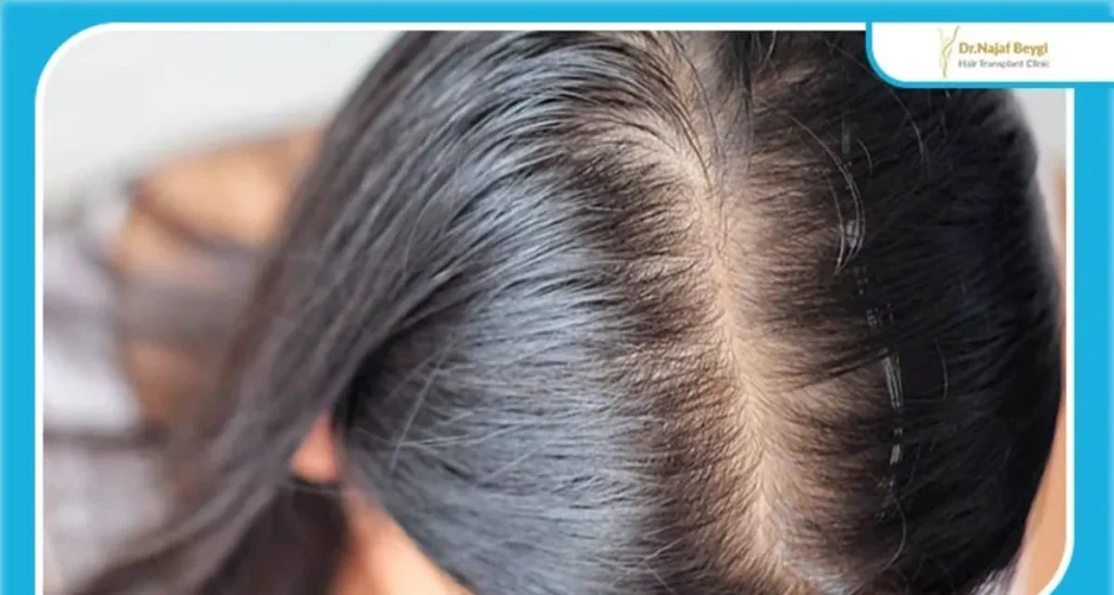 علت ریزش موی شدید و ناگهانی و راه های درمان آن