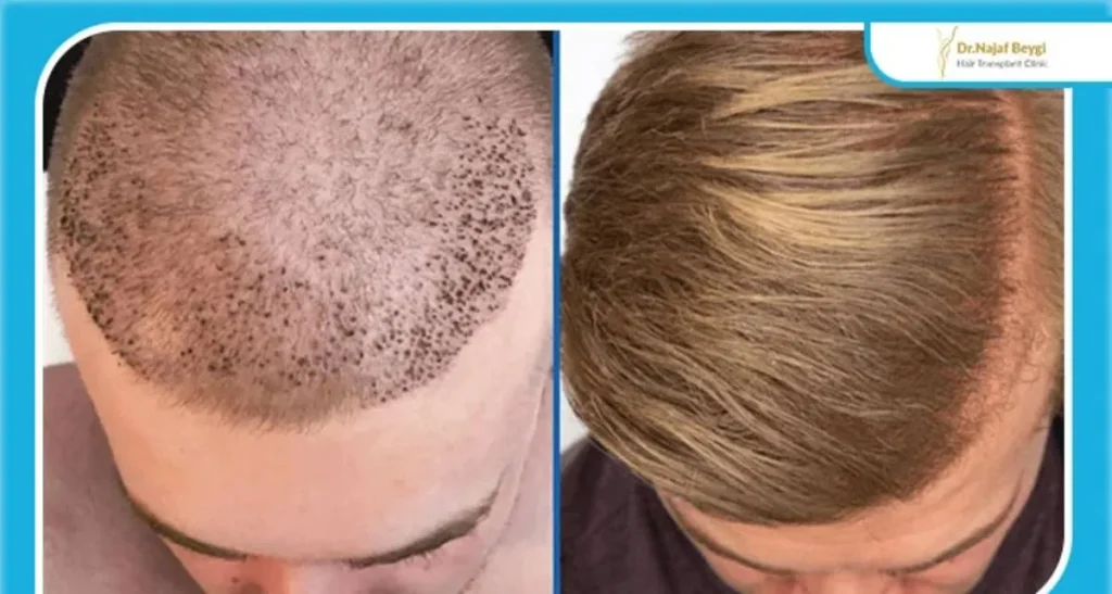 تفاوت بین کاشت مو و ترمیم مو