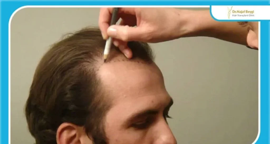 تفاوت ترمیم مو و کاشت مو و کاربرد هر کدام