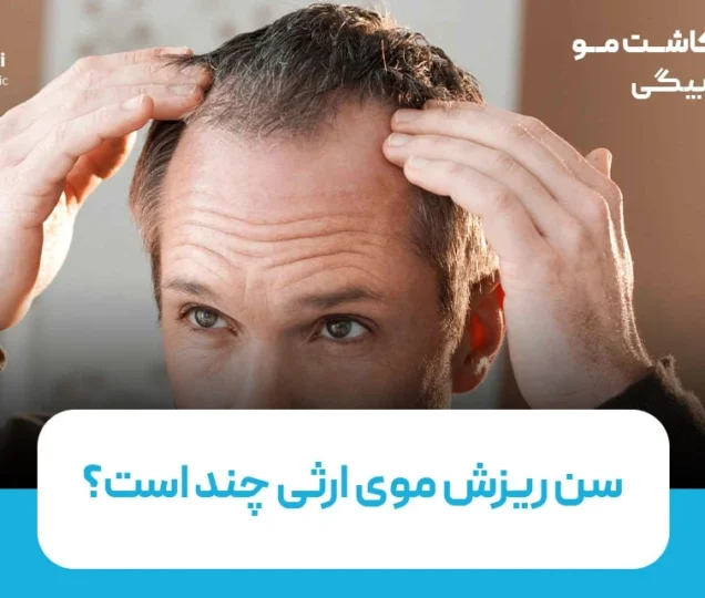 سن ریزش موی ارثی چند است؟