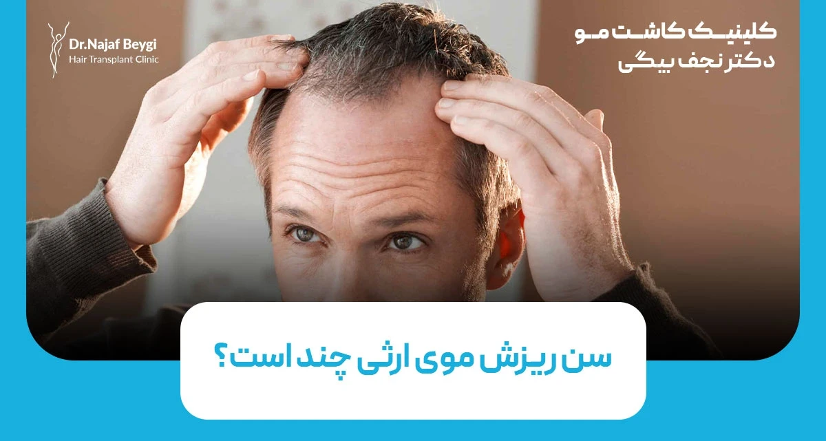 سن ریزش موی ارثی در مردان و زنان؛ شروع و توقف از چند سالگی است؟