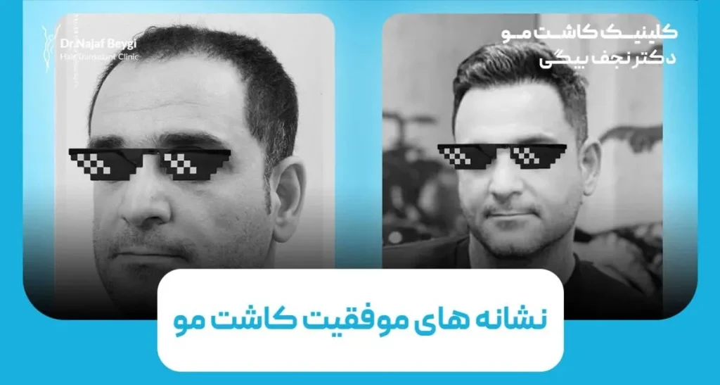 نشانه های موفقیت کاشت مو چیست؟