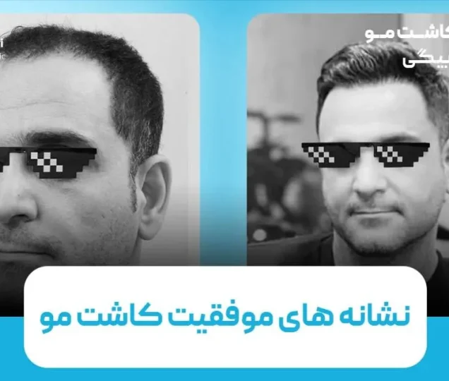 نشانه های موفقیت کاشت مو چیست؟