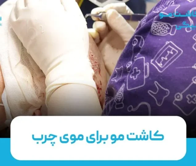 کاشت مو برای موی چرب امکان پذیر است؟