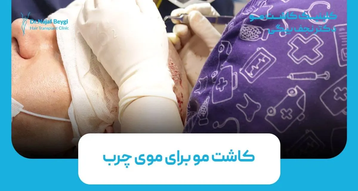 کاشت مو برای موی چرب امکان پذیر است؟