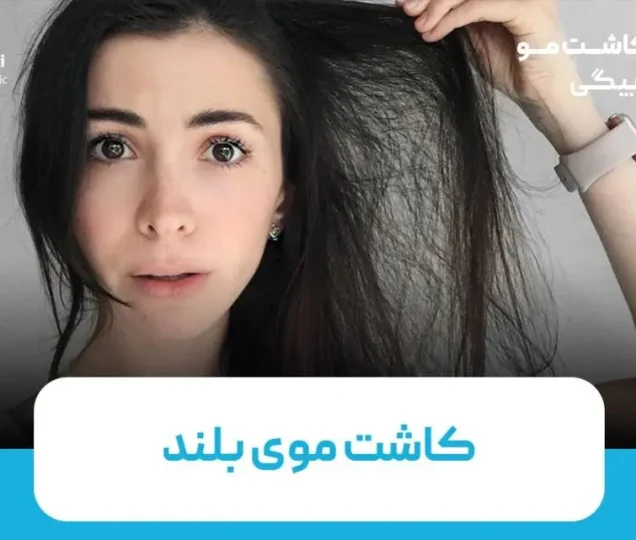 کاشت موی بلند راهی نوین برای زیبایی طبیعی