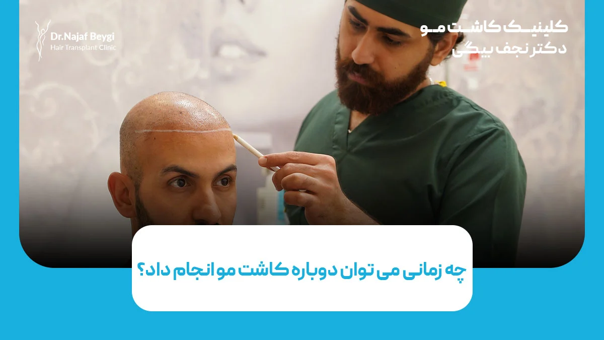 کاشت مو برای بار دوم