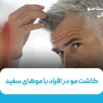 کاشت مو در افراد با موهای سفید