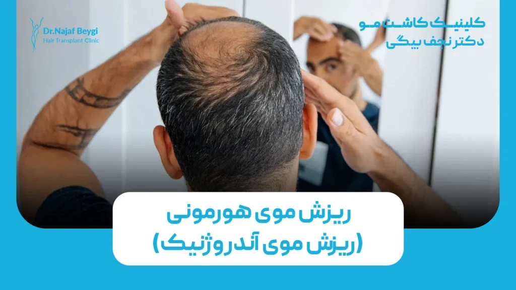 ریزش موی هورمونی