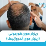 ریزش موی هورمونی