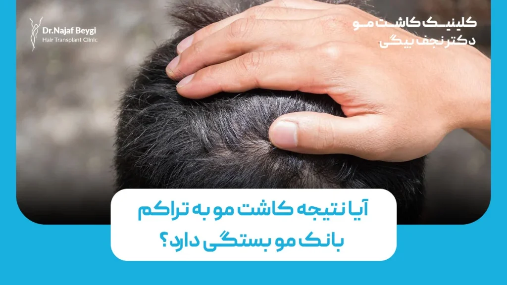 آیا نتیجه کاشت مو به تراکم بانک مو بستگی دارد؟