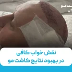 نقش خواب کافی در بهبود نتایج کاشت مو