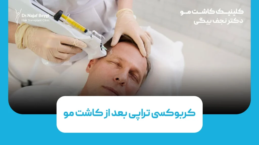 کربوکسی تراپی بعد از کاشت مو