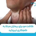 کاشت مو برای بیماران مبتلا به کم‌کاری تیروئید