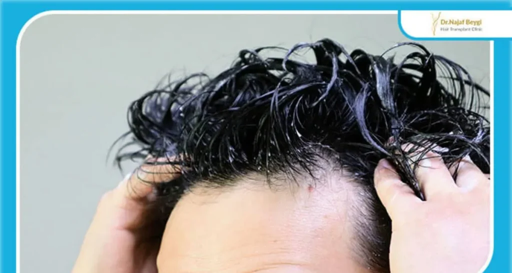 آیا ماساژ موهای کاشته شده ضرر دارد