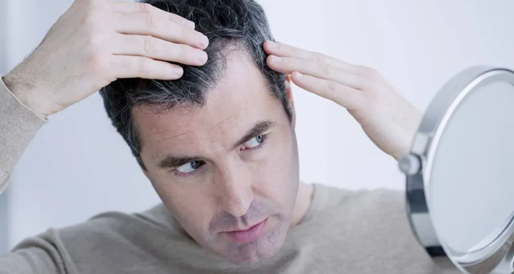 تأثیر تعریق پس از کاشت مو