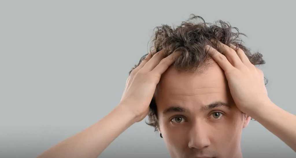 نکات کاشت مو برای افراد با تعریق زیاد