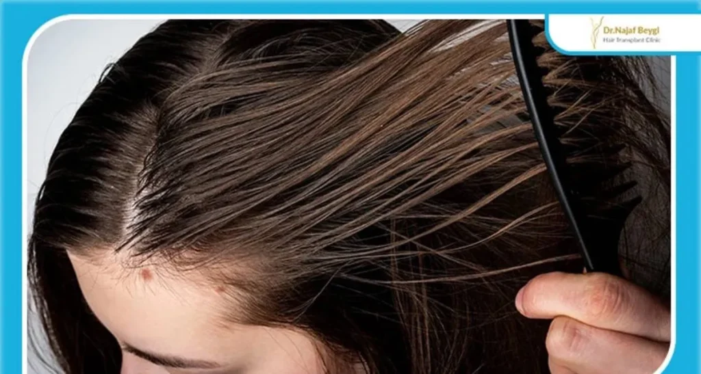 کاشت مو برای افراد با تعریق بالا