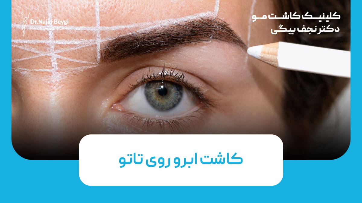 کاشت ابرو روی تاتو