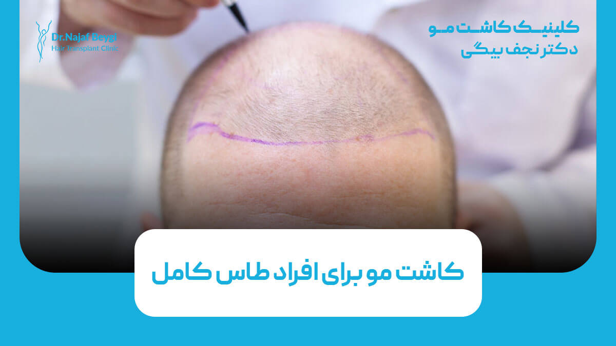 کاشت مو برای افراد طاس کامل