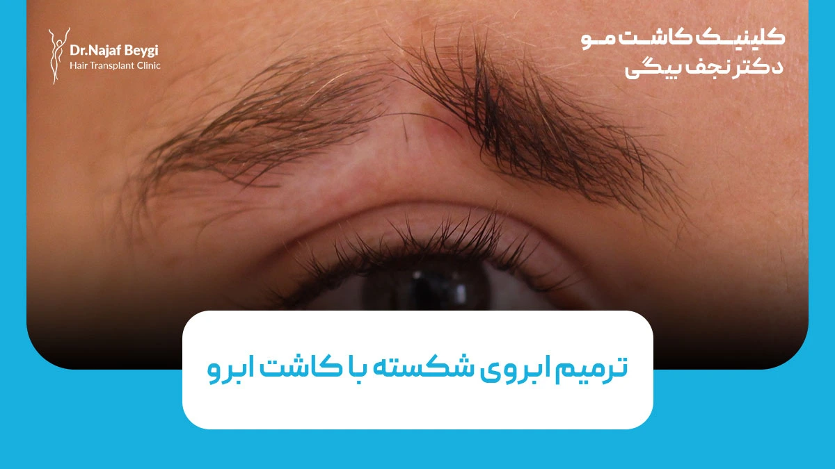 ترمیم ابروی شکسته با کاشت ابرو