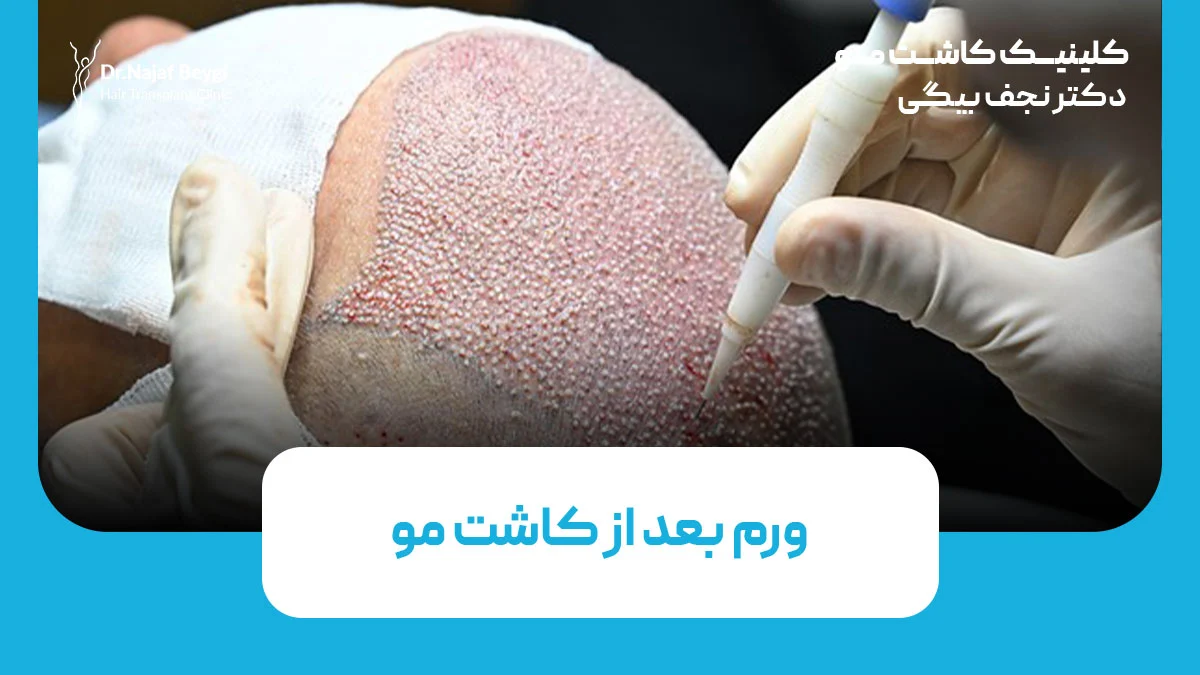 ورم بعد از کاشت مو
