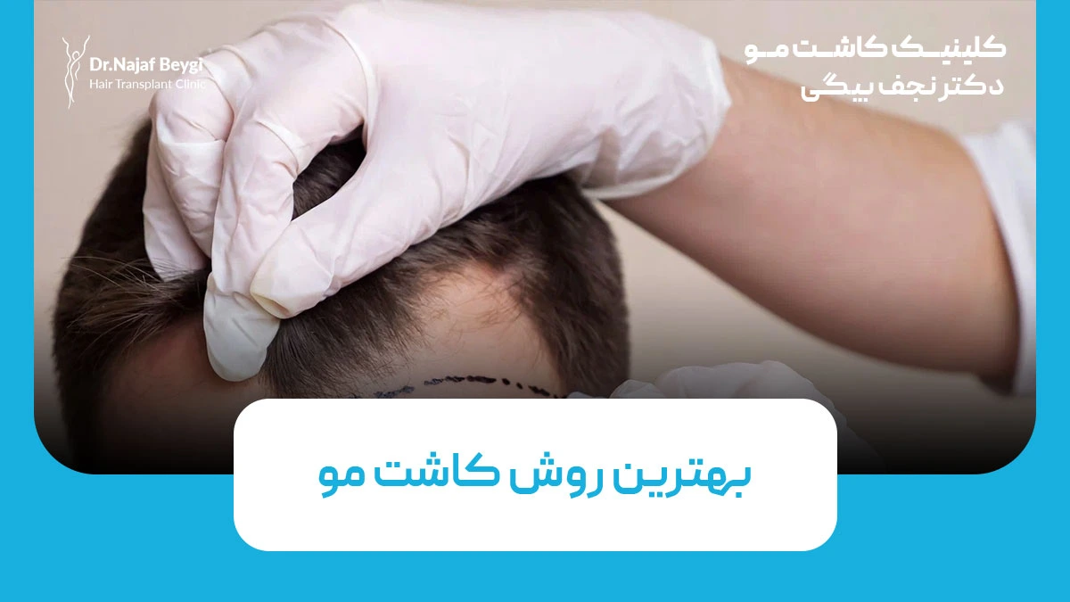 بهترین روش کاشت مو