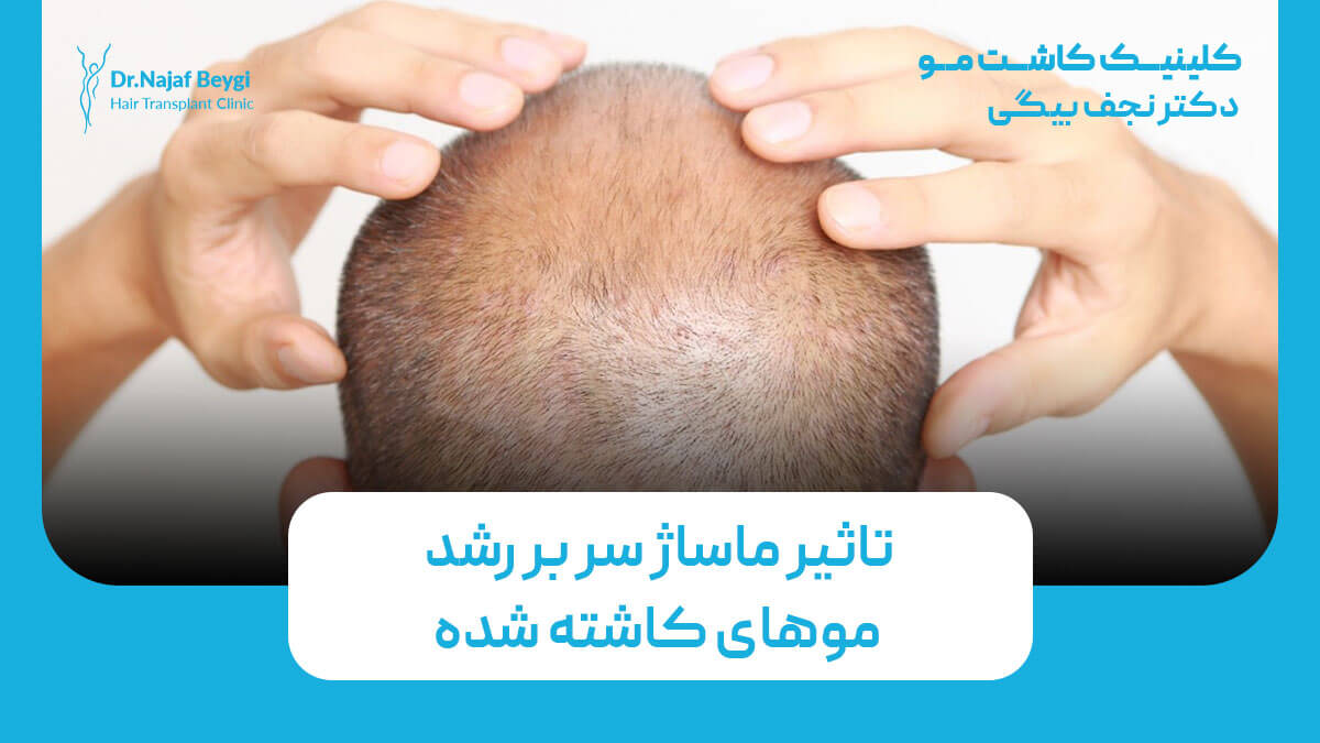 تاثیر ماساژ سر بر رشد موهای کاشته شده